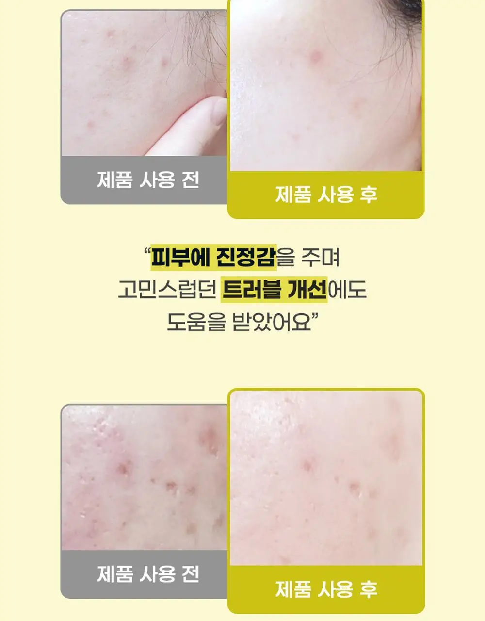 [트러블/과잉피지완화]앰플엔 아크네샷 앰플 30ml 상세페이지 8